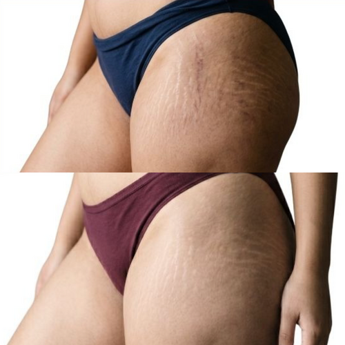 Cryo Thermo Cellulite Gel